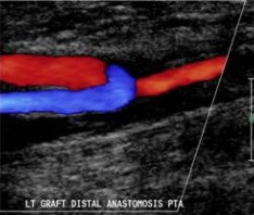 Bypass Graft Evaluation