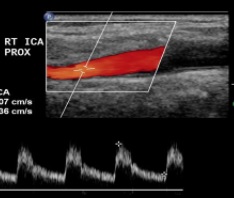 Peripheral Arterial Duplex