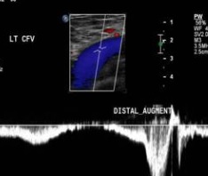 Peripheral Arterial Duplex