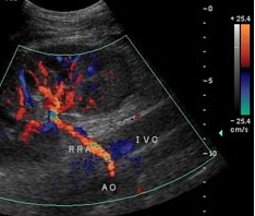 Renal Artery Duplex