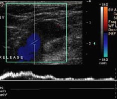 Varicose Vein Assessment