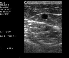 Vein Mapping