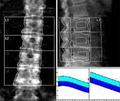 DEXA