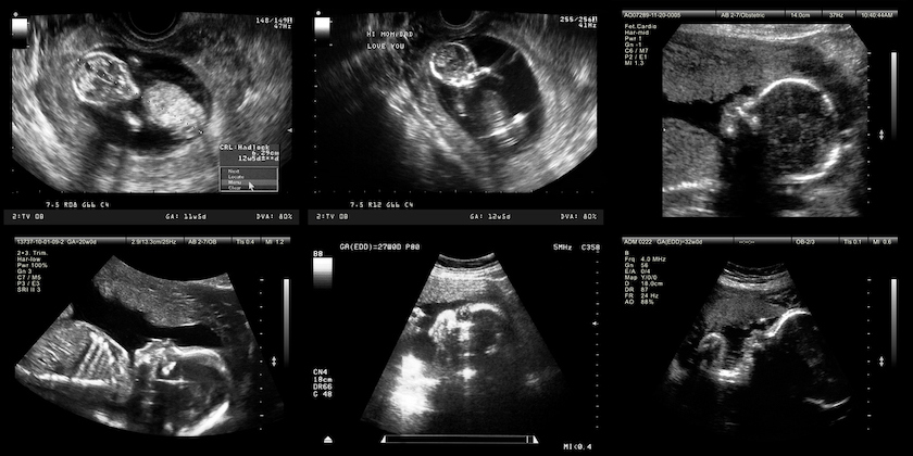 Ultrasound UC Davis