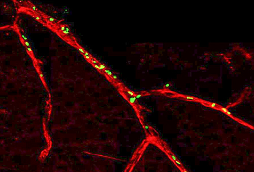 Macular Degeneration