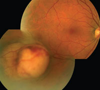 PHOTO — Micheal Bone's choroidal melanoma can be seen in these photos of his retina. The tumor is the lighter-colored lesion in the lower left image.