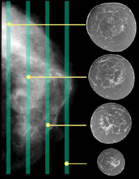 PHOTO — Cathryn Sant participated in a clinical trial comparing breast CT to mammography. Both technologies detected her early malignancies.