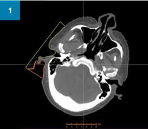 CT scan of the patient’s head, overlaid with outlines of the boluses to be created 