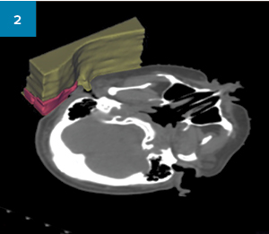 CT scan with 3D depiction of the boluses