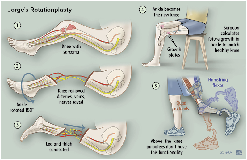 Jorge’s Rotationplasty illustration