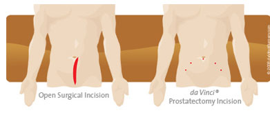 Prostatectomy incisions - open surgery vs. robotic-assisted surgery