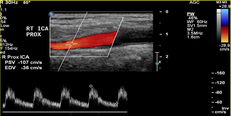 Normal carotid artery