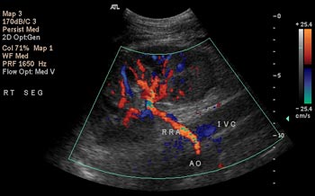 renal artery duplex scan