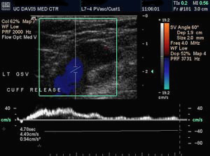 Venous insufficiency