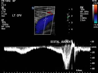 Deep Vein Thrombosis